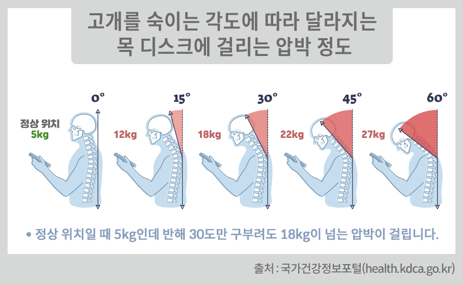 고개를 숙이는 각도에 따라 달라지는 목 디스크에 걸리는 압박 정도